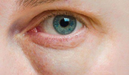 Какие заболевания могут стать причиной мешков под глазами?